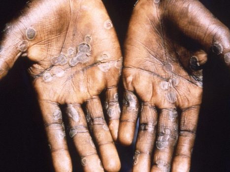 Monkeypox diagnosed in Belgium, the virus appears more and more in Europe |  health